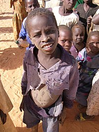 Child at a MSF camp in Chad.jpg